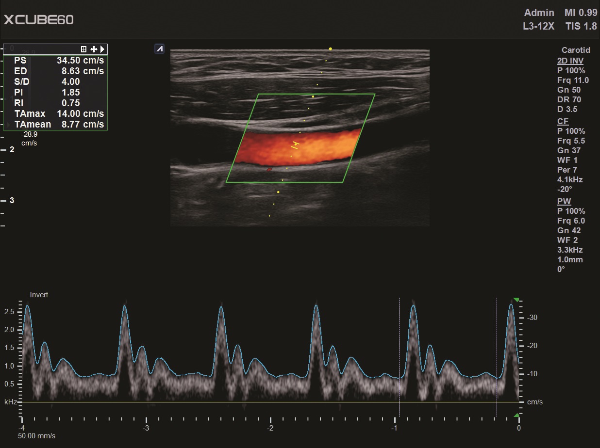Carotid in PW mode