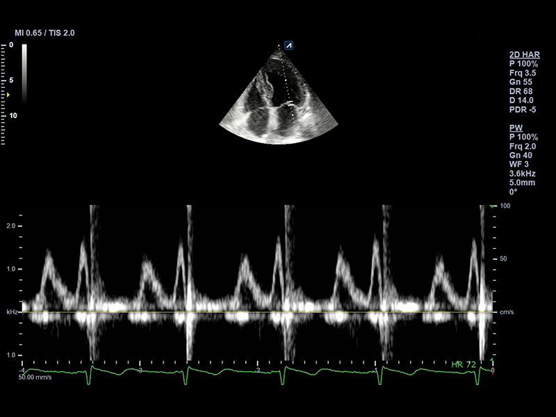 Apical view 4 chamber PW Mitral valve Diastolic function Mild Dysfunction