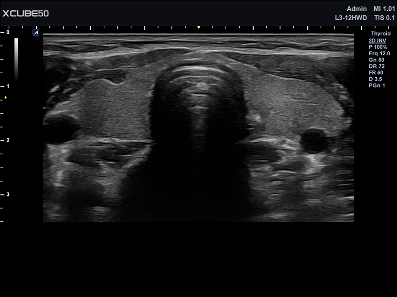 Thyroid