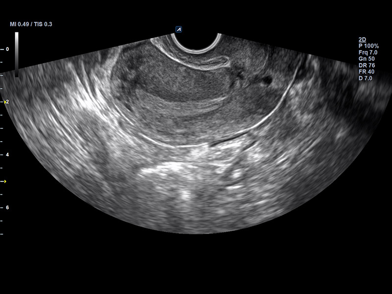 Uterus Longitudinal view 2D Normal pelvic ultrasound