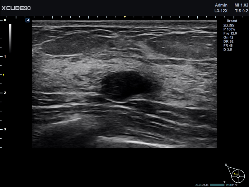 Breast nodule in 2D mode