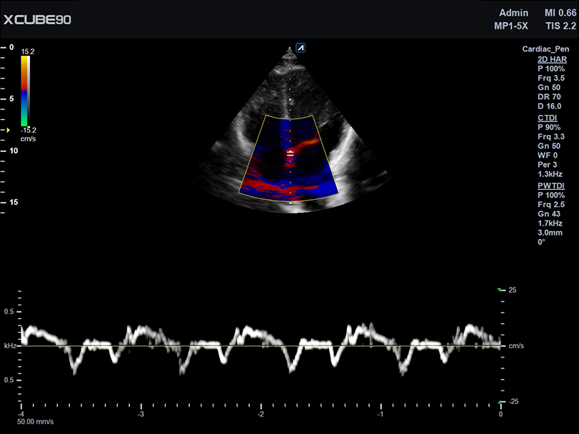 Cardiac TDI in PW mode