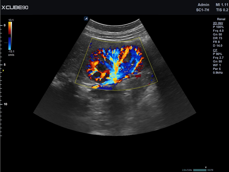Kidney-in-CF-mode
