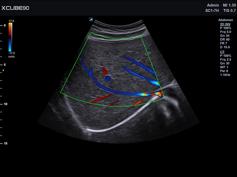 Liver-in-CF-mode
