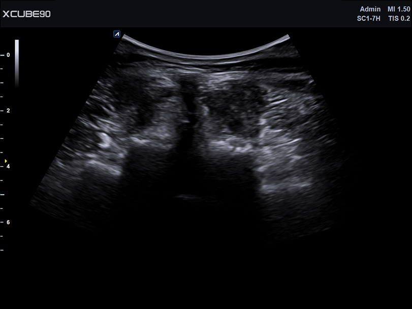 Lumbar Spine in 2D mode