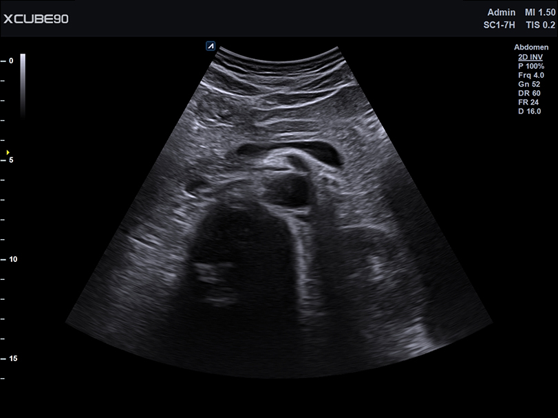 Pancreas
