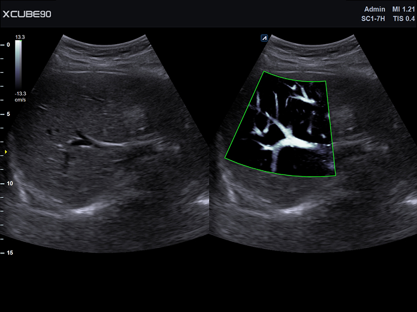 Portal vein X+MicroView