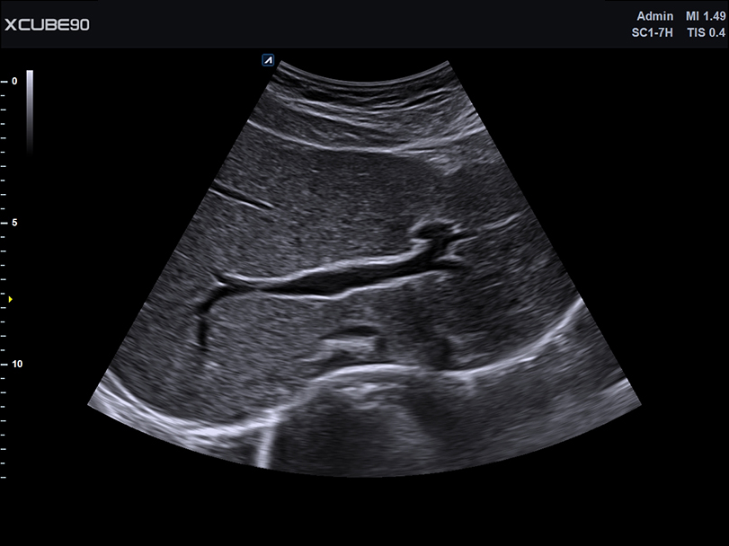 Portal vein