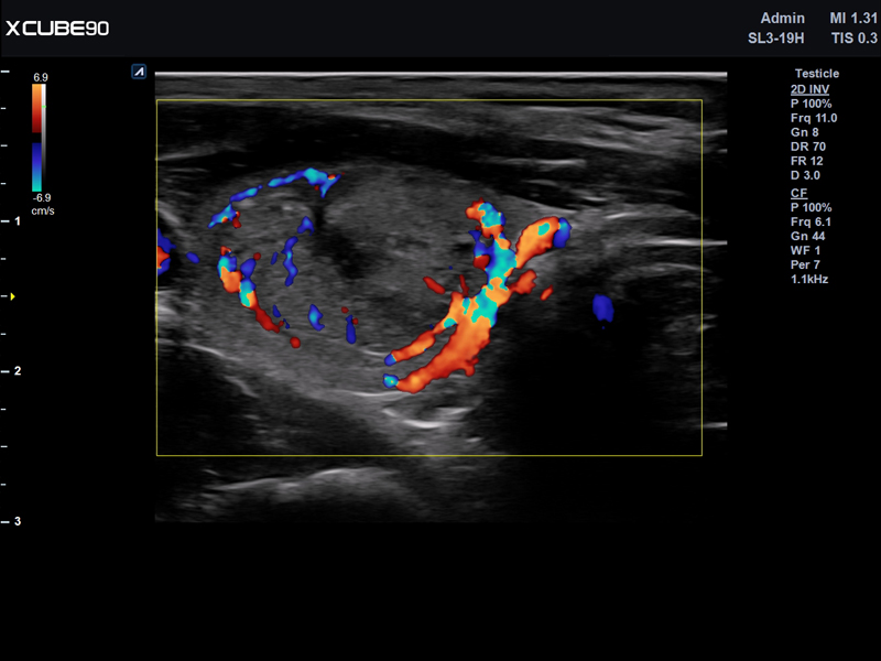Thyroid nodule in CF mode