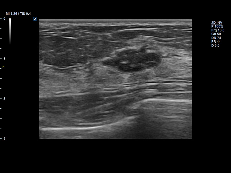 Breast 2D Fibroadenoma