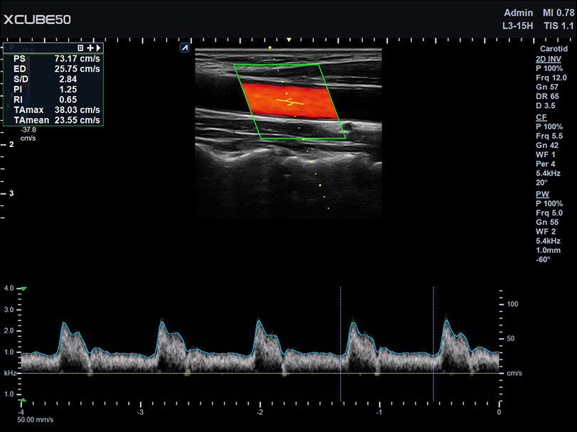 Carotid