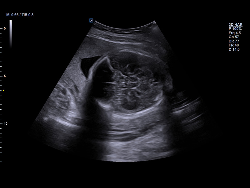 Fetal brain 2D Normal case
