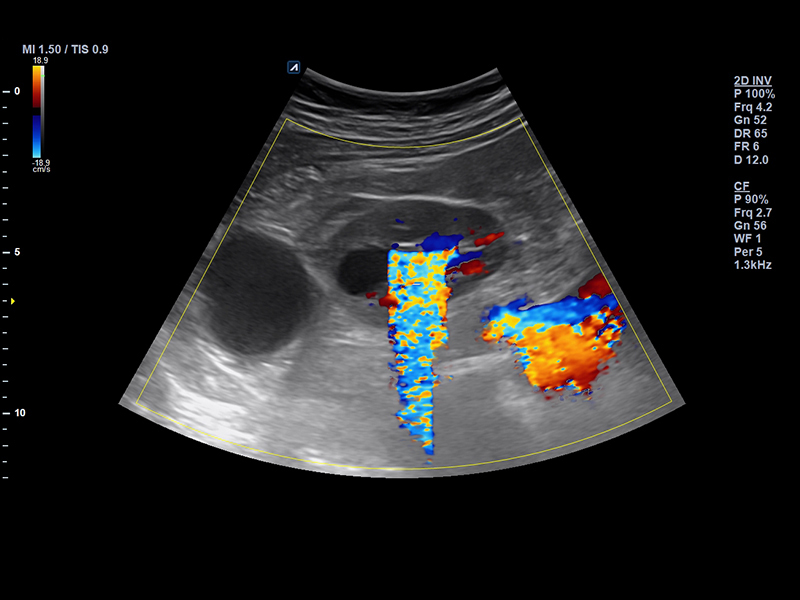 Kidney(Renal stone) Color mode Twinkle artifact