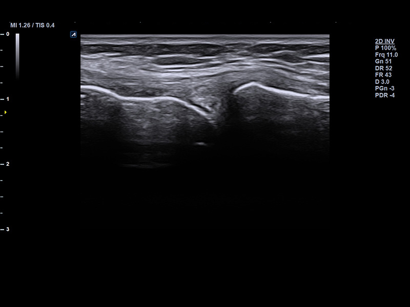 Knee meniscus 2D