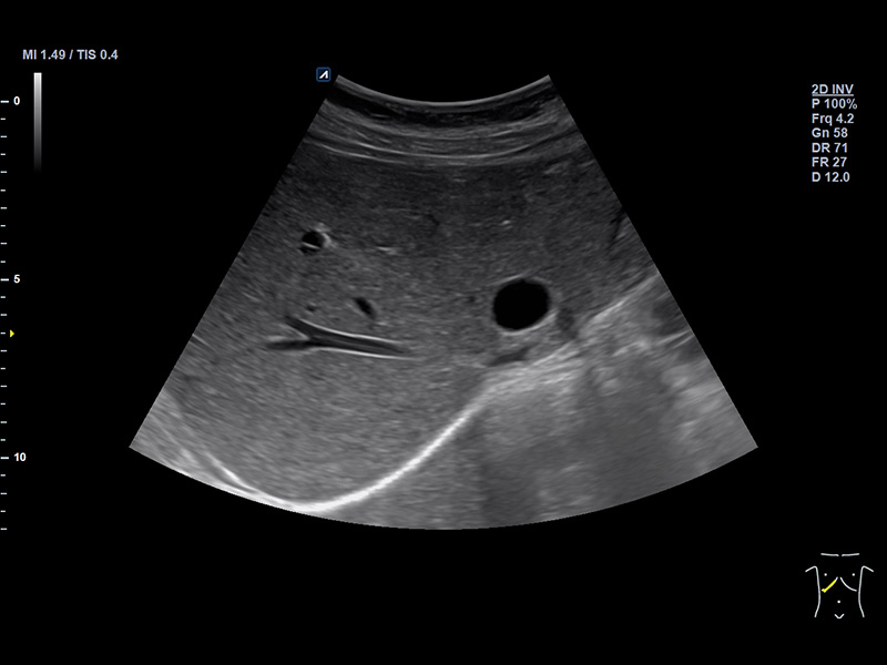 Liver 2D Liver cyst(Hepatic cyst)