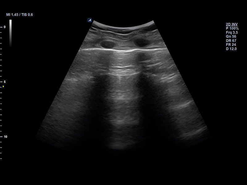 Lung A-line 2D Normal case