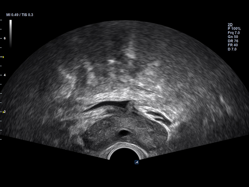 Prostate 2D Normal case