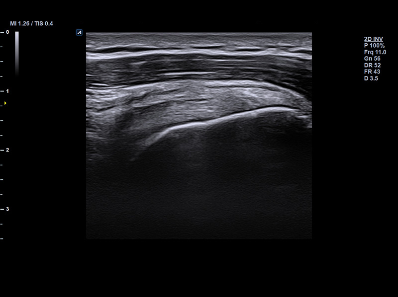 Shoulder supraspinatus 2D